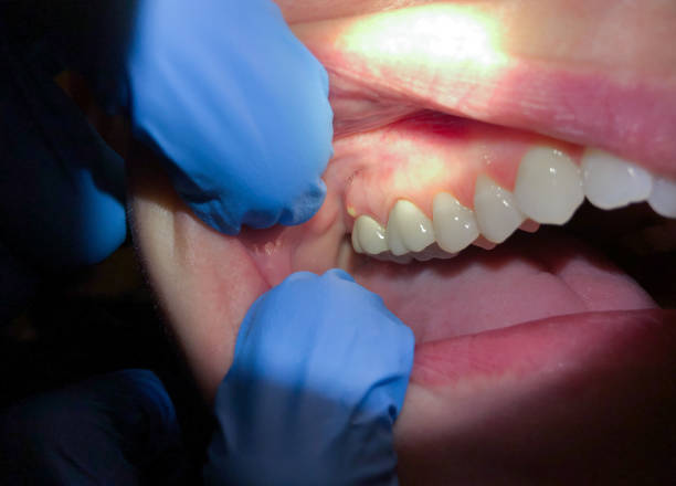 Best Emergency Wisdom Tooth Extraction in Mount Vernon, KY